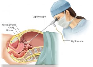 Gynaec Laparoscopic surgeon in aundh