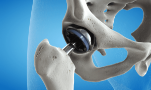 Hip Replacement Surgeon in Aundh