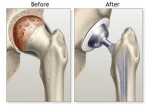 Hip Replacement Surgeon in Aundh