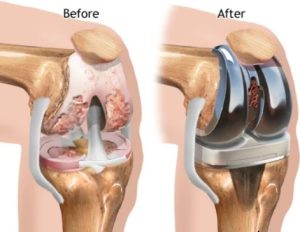 Joint Replacement Surgeon in Aundh
